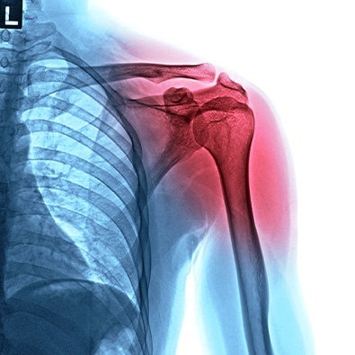 Digital x-ray of A-C joint injury