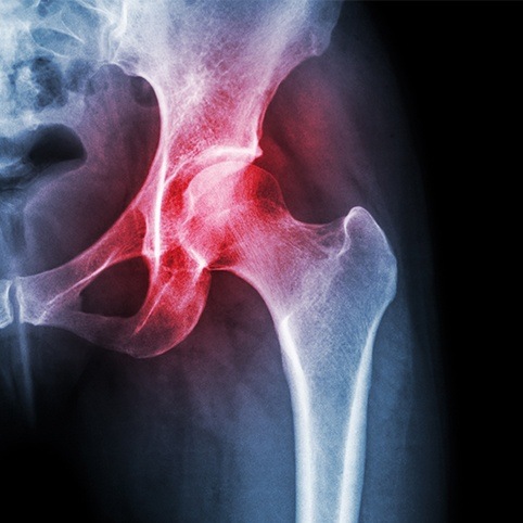 X-ray of hip with impingement injury