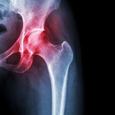 X-ray of hip with damage caused by osteoarthritis