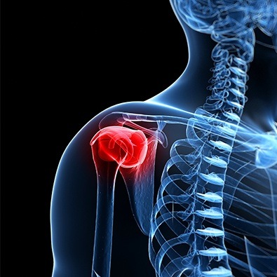 3D animation of shoulder with labral tear