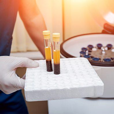 Doctor holding separated plasma for stem cell treatment