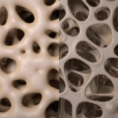 Closeup of bone before and after osteoarthritis