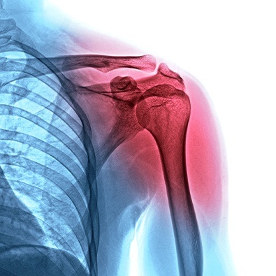X-ray of A-C shoulder injury