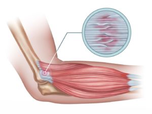 Illustration of tennis elbow, which might benefit from regenerative medicine